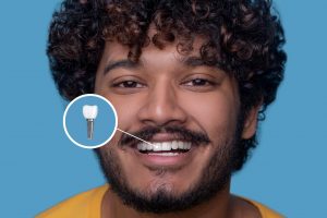implante dentário com parafuso de titânio
